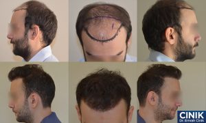 Hair Transplant in Turkey