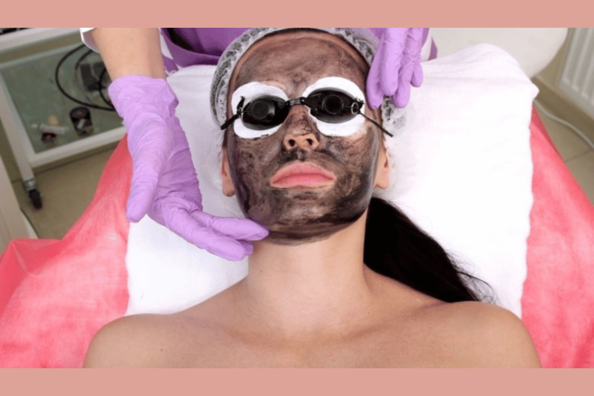 Carbon Laser Peel