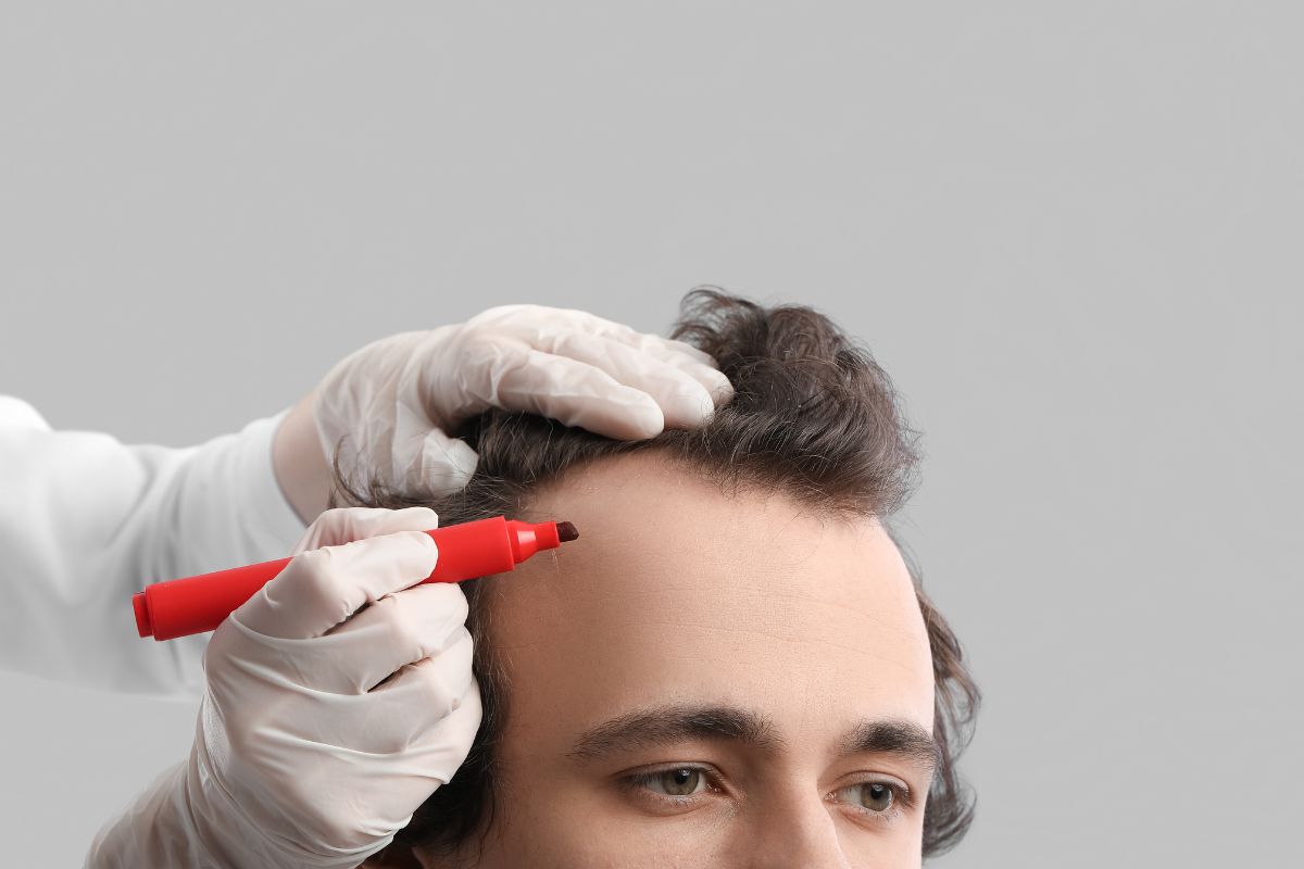 FUE Hair Transplant
