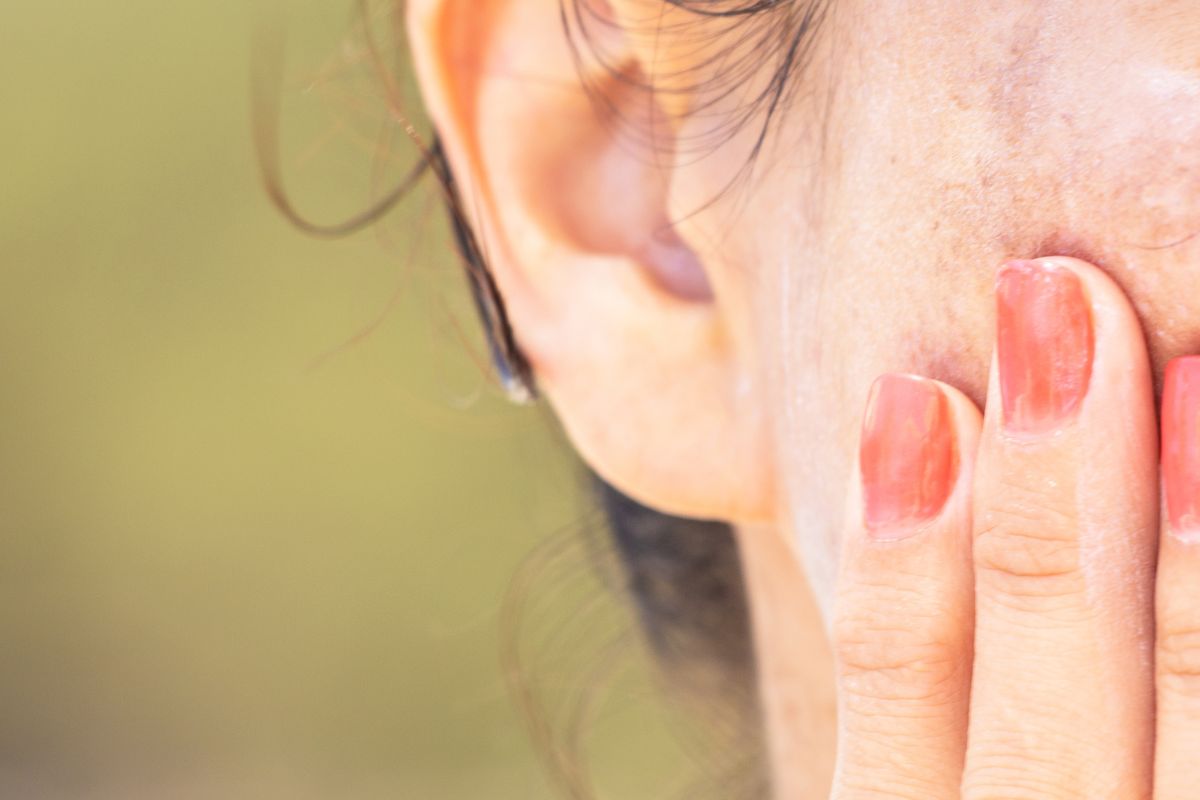 Pigmentation Treatment