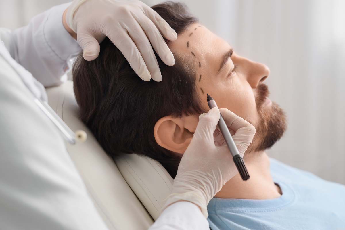 Best Hair Transplant