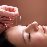 acupuncture