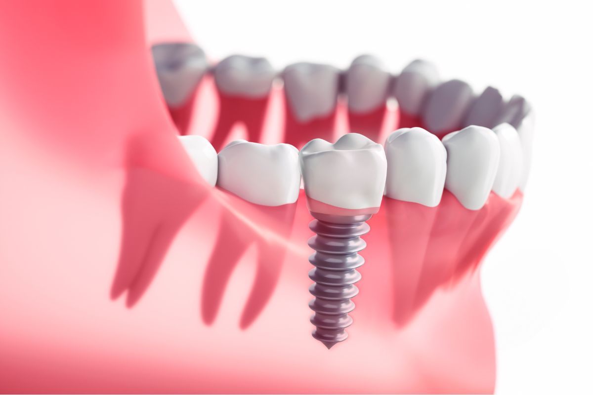 Dental Implants